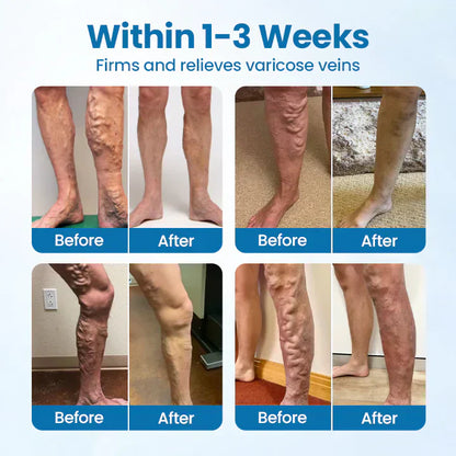 Leg Relief Varicose Veins Cream 50g – Soothing Lotion for Pain, Swelling & Circulation
