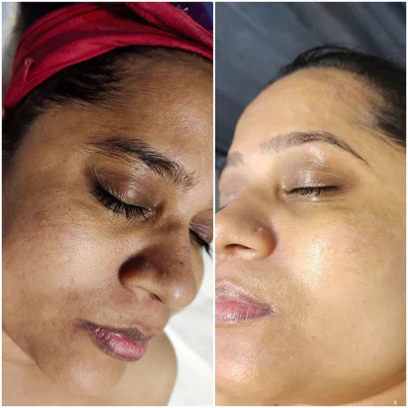✨Fast Dark Spot Remover-vuriexo™  Melanin Correcting Facial Serum(🔥Last Day Promotion 60% OFF)