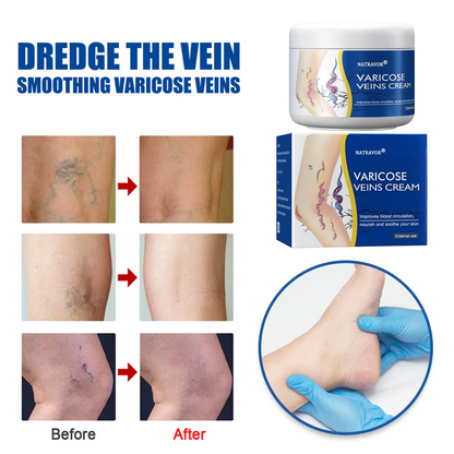 Leg Relief Varicose Veins Cream 50g – Soothing Lotion for Pain, Swelling & Circulation
