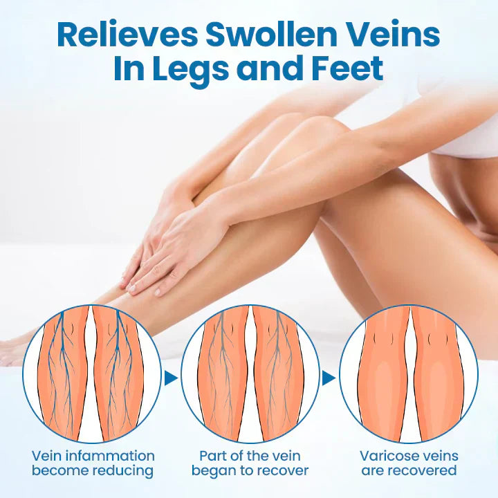 Leg Relief Varicose Veins Cream 50g – Soothing Lotion for Pain, Swelling & Circulation