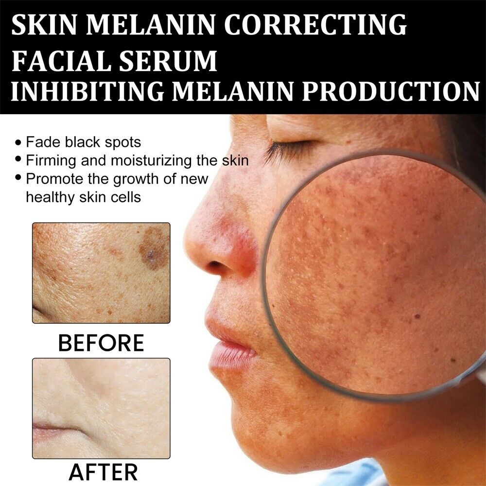 ✨Fast Dark Spot Remover-vuriexo™  Melanin Correcting Facial Serum(🔥Last Day Promotion 60% OFF)