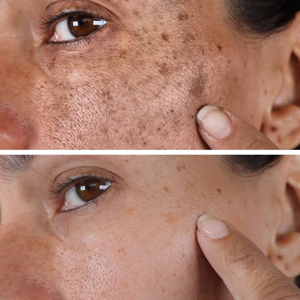 ✨Fast Dark Spot Remover-vuriexo™  Melanin Correcting Facial Serum(🔥Last Day Promotion 60% OFF)