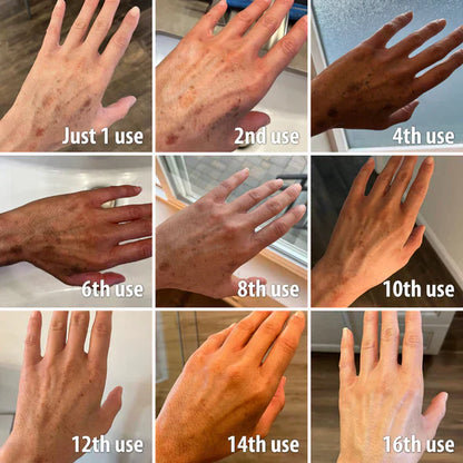 ✨Fast Dark Spot Remover-vuriexo™  Melanin Correcting Facial Serum(🔥Last Day Promotion 60% OFF)