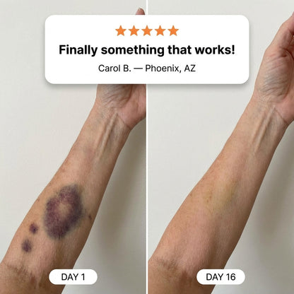 💥100K+ SOLD💕- NATRAVOR® Bruise Repair & Skin-Strengthening Cream